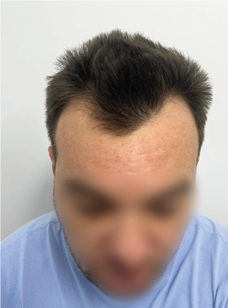 Inainte de procedura